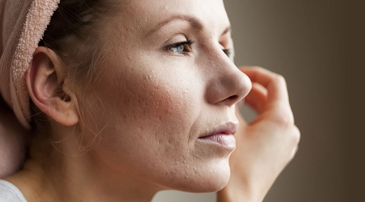 Eczema That Won’t Quit? Here’s What Helps