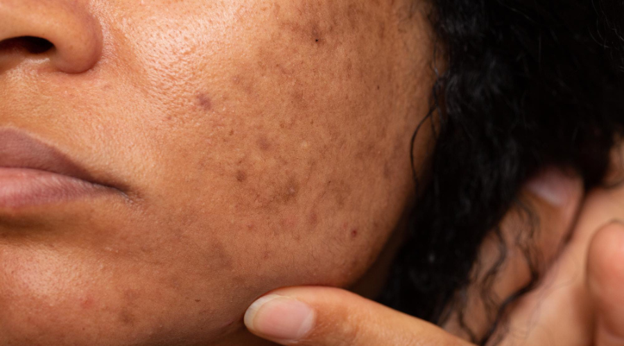 How to Get Rid of Pigmentation & Dark Spots | Best Skin Care Routine