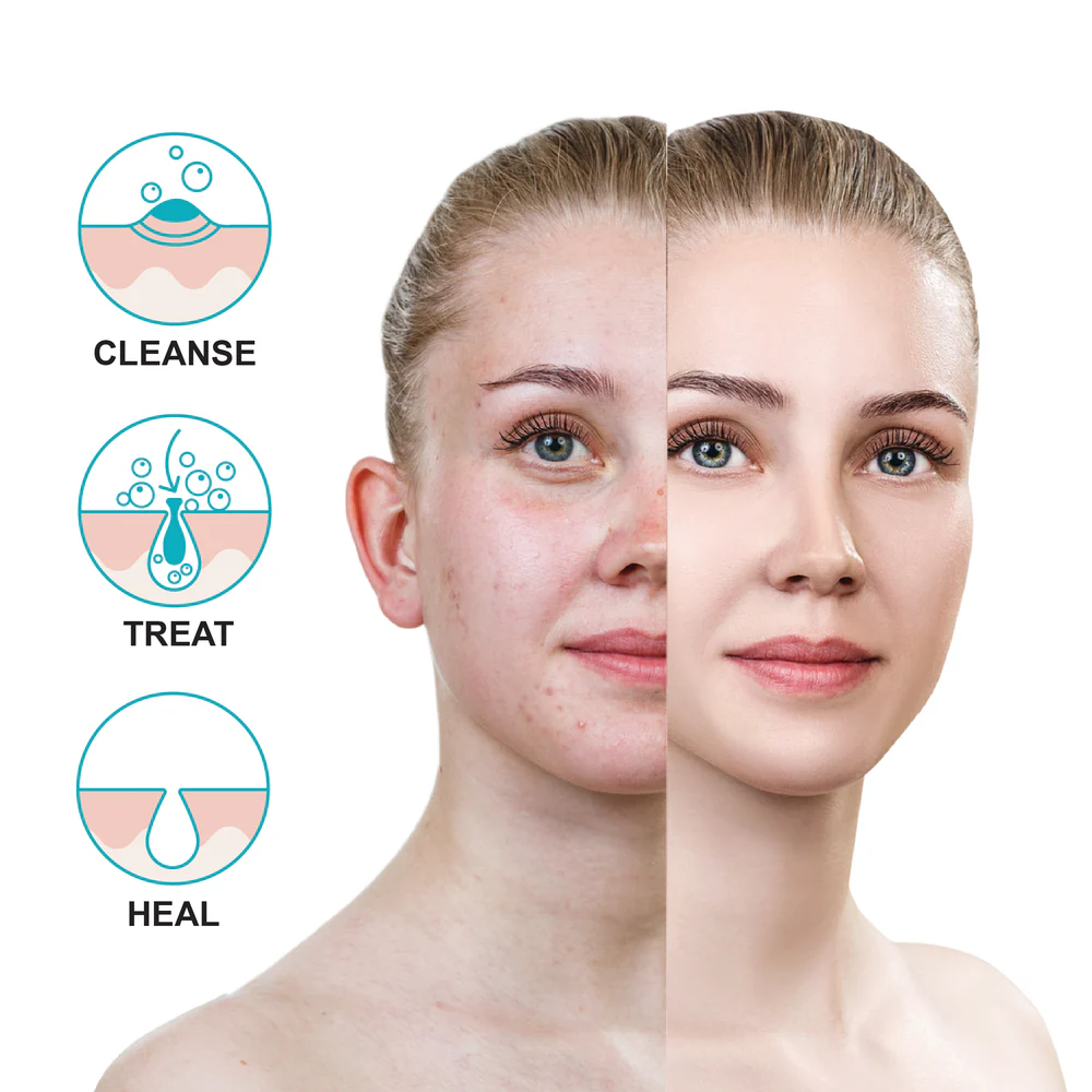Affordable creams for pimple 